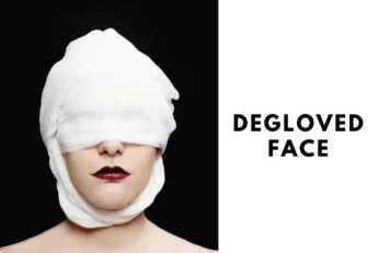 degloved face